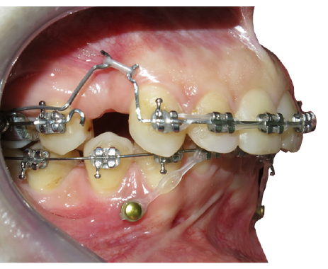 Ortodoncija fiksna proteza mini implanti