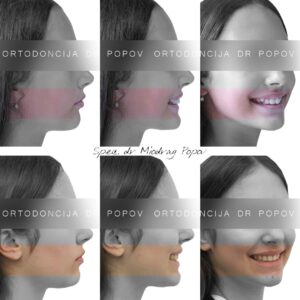 Distalan zagrižaj sa dubokim zagrižajem