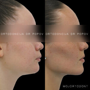 sagitalan problem, distalan zagrižaj , protruzija gornjih sekutića