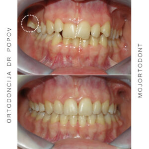 problem prostora- teskoba; transverzalni problem- jednostrano ukrsten zagrižaj