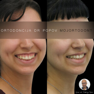 ortodoncija dr Popov