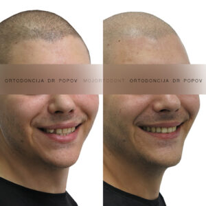 Asimetrija, ektopicno postavljen zub