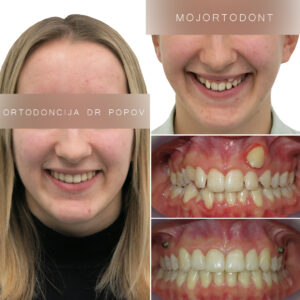 asimetrija- ektopicno postavljen zub; problem prostora- teskoba