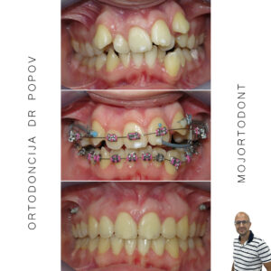 problem prostora- teskoba; sagitalna problem- Distalan zagrižaj; Asimetrija- nesuklađane sredine zubnih nizova, nagnuta okluzalna ravan