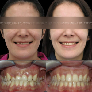 Sagitalni problem III klasa