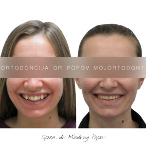 sagitalan problem, II klasa